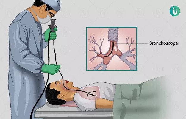ശ്വാസകോശത്തിനുള്ളിൽ ക്യാമറ എത്തുമ്പോൾ; ബ്രോങ്കോസ്കോപ്പിയെക്കുറിച്ച് അറിയേണ്ടതെല്ലാം